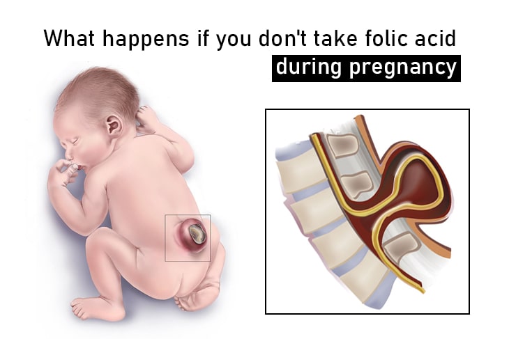 What happens if you don't take folic acid during pregnancy